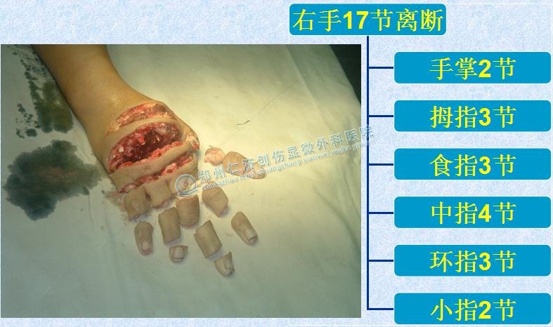手指离断十七截